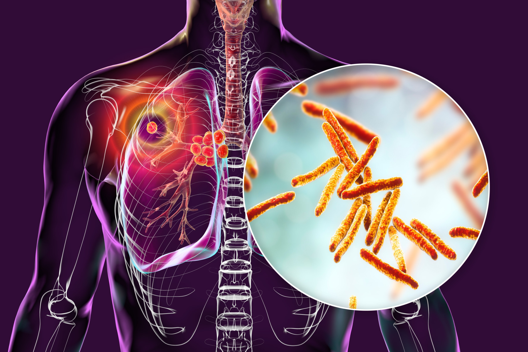 Tuberculosis Doctor in Greater Noida